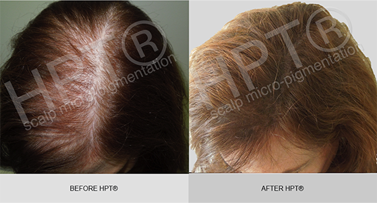 HPT® for female hair loss