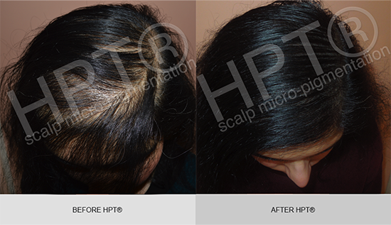 HPT® for female hair loss