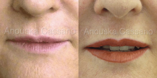 Lip Correction