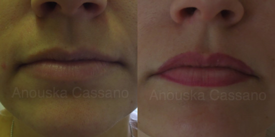 Lip Enhancement